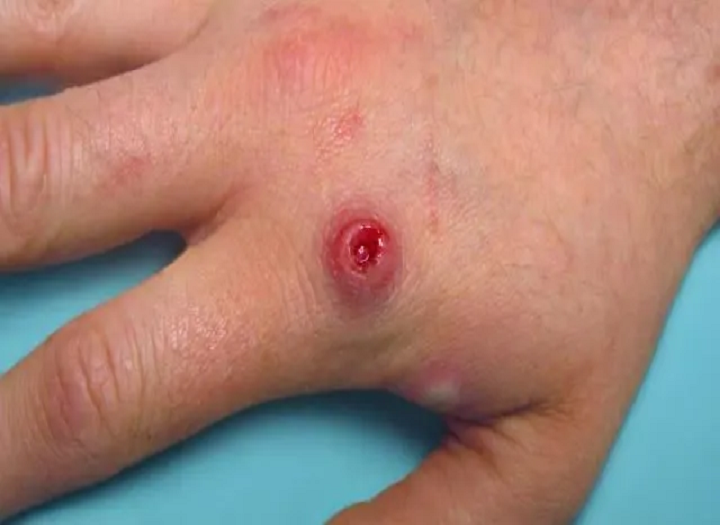 Monkeypox anlamaq və bunun qarşısını necə almaq olar?